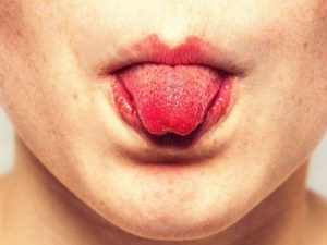 Червоні плями язика у дорослих та дітей: що робити?