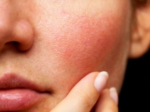 Про які хвороби можуть говорити висипання на шкірі